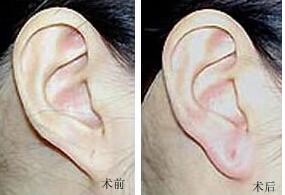 萍鄉(xiāng)耳垂加大價(jià)格