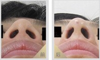 湘西鼻頭鼻翼縮小價格