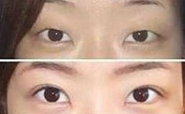 眼瞼下垂矯正價(jià)格