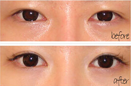 亳州眼瞼粘連術(shù)價(jià)格