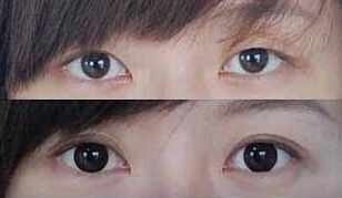 亳州眼瞼外翻整復(fù)價(jià)格