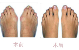 萍鄉拇外翻（大腳骨）矯正價格