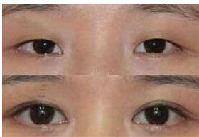 撫順雙眼皮價(jià)格