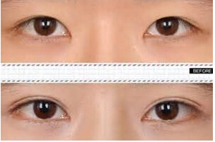 撫順雙眼皮失敗修復(fù)價(jià)格