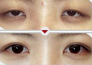 撫順上瞼松弛矯正術(shù)價格