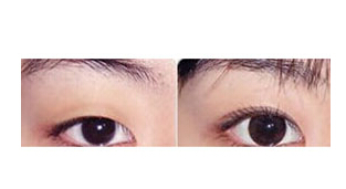 撫順眼瞼下垂矯正價(jià)格