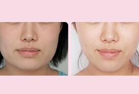 寧德去咬肌瘦臉價(jià)格