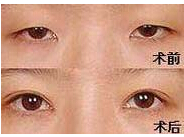 撫順眼部綜合術價格