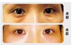 撫順眼苔再造價格