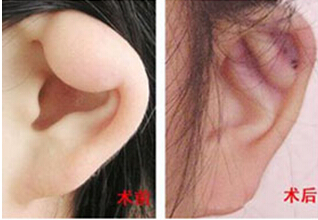 湘西耳垂畸形修復價格