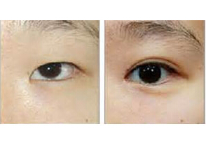 埋线双眼皮案例