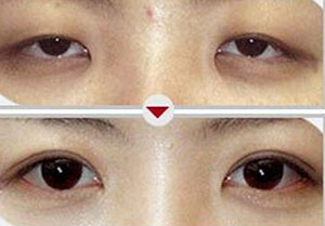 揚州上瞼松弛矯正術(shù)價格