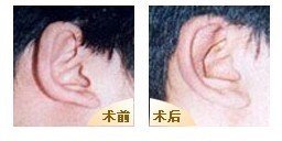 南京穿耳孔價格