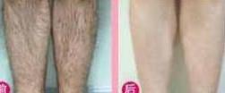 寶雞大小腿脫毛價格