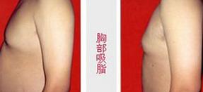 寶雞胸部吸脂價格