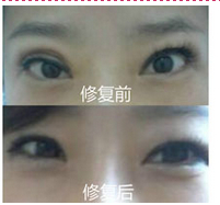 煙臺雙眼皮失敗修復價格