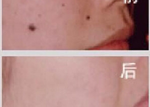 亳州點痣價格