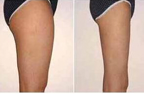 撫順大腿吸脂價(jià)格