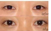 煙臺瞼眶溝填充價格