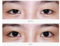 煙臺(tái)三角眼矯正價(jià)格