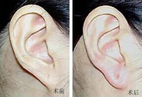亳州耳垂加大價格