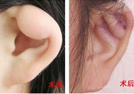 亳州耳垂畸形修復價格