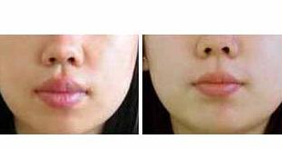寧德厚唇修薄價(jià)格