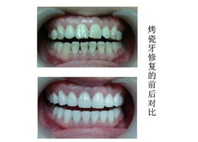 南京烤瓷牙價格