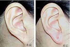 揚州耳垂加大價格