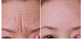 撫順E光除皺價格