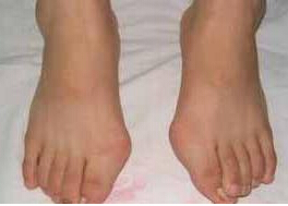 撫順拇外翻畸形矯正價格