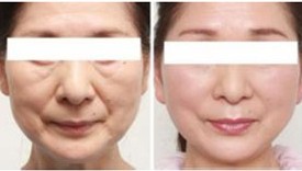 臨滄激光去老年斑價(jià)格