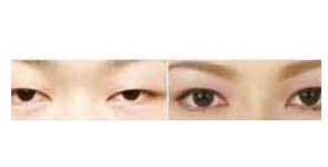忻州眼瞼下垂矯正價(jià)格