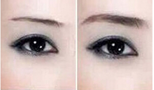 忻州切眉術價格