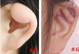 寧德耳垂畸形修復(fù)價(jià)格