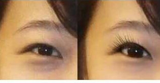 忻州去黑眼圈價(jià)格