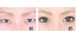 忻州眼部綜合術(shù)價(jià)格