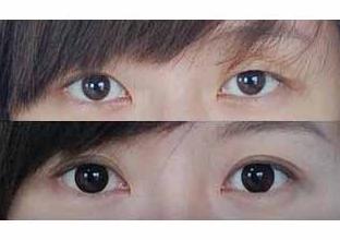 保定眼瞼缺損整復(fù)術(shù)價(jià)格
