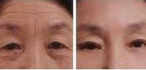 臨滄生物除皺價格