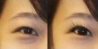 承德去黑眼圈價格