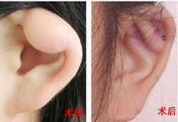 煙臺(tái)耳垂畸形修復(fù)價(jià)格