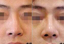 承德歪鼻整形價格