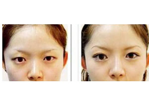 双眼皮手术案例