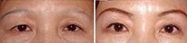 滄州眉弓填充價格