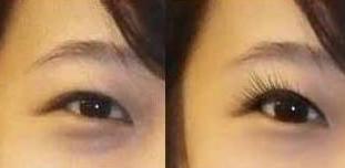 滄州去黑眼圈價(jià)格