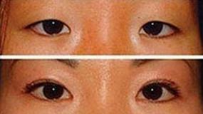 滄州眼部綜合術價格