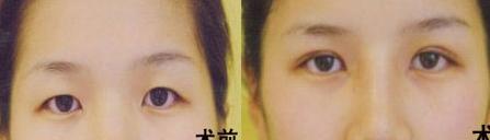 滄州水泡眼矯正價格