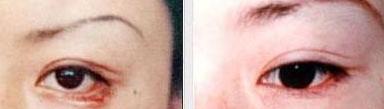 滄州眼瞼外翻整復(fù)價(jià)格