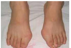 煙臺(tái)拇外翻（大腳骨）矯正價(jià)格