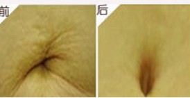 臨滄肚臍整形價(jià)格